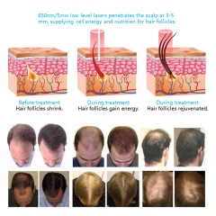 Laser Hair Regrowth System Treat Hair Loss Men Women Balding